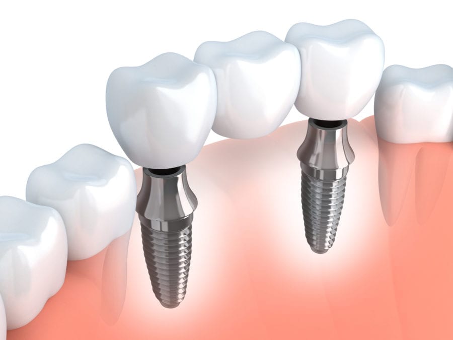 Iqaluiit Dental Clinic dental-implant-
